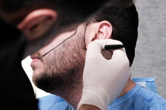 Beard hair transplant procedure close-up