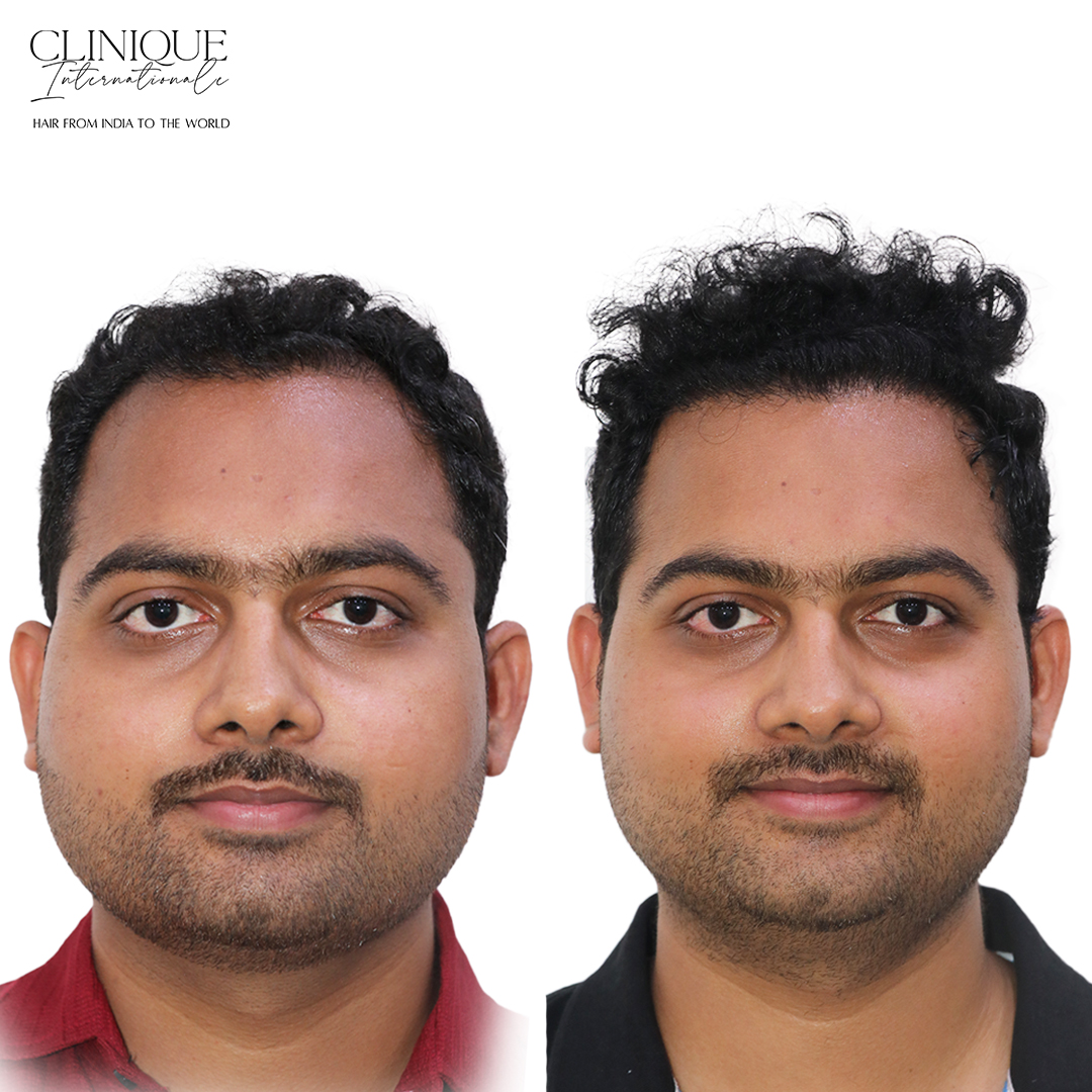 Hair Transplant Before After – Amit Parihar, Mumbai