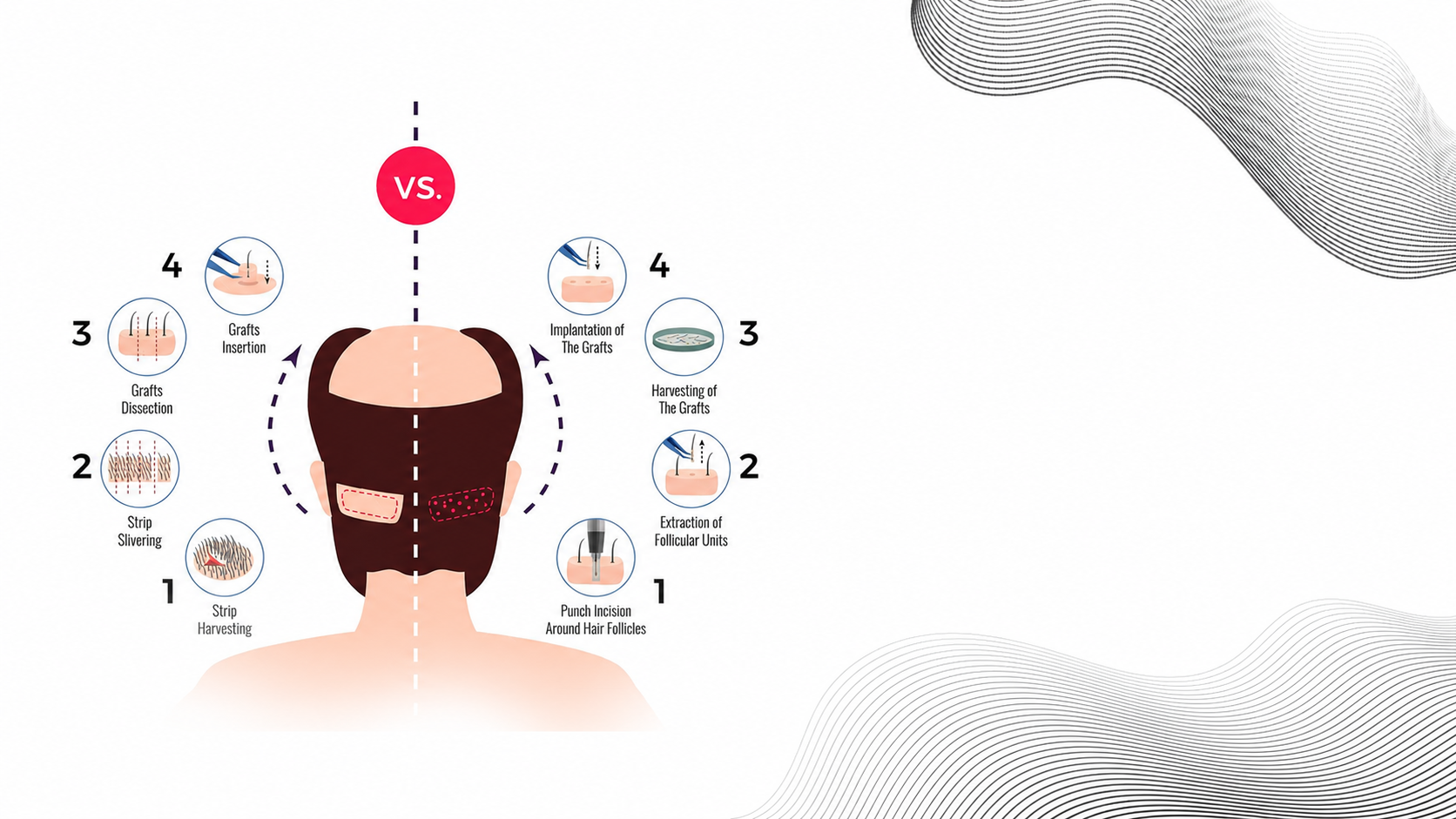 FUE Hair Transplant