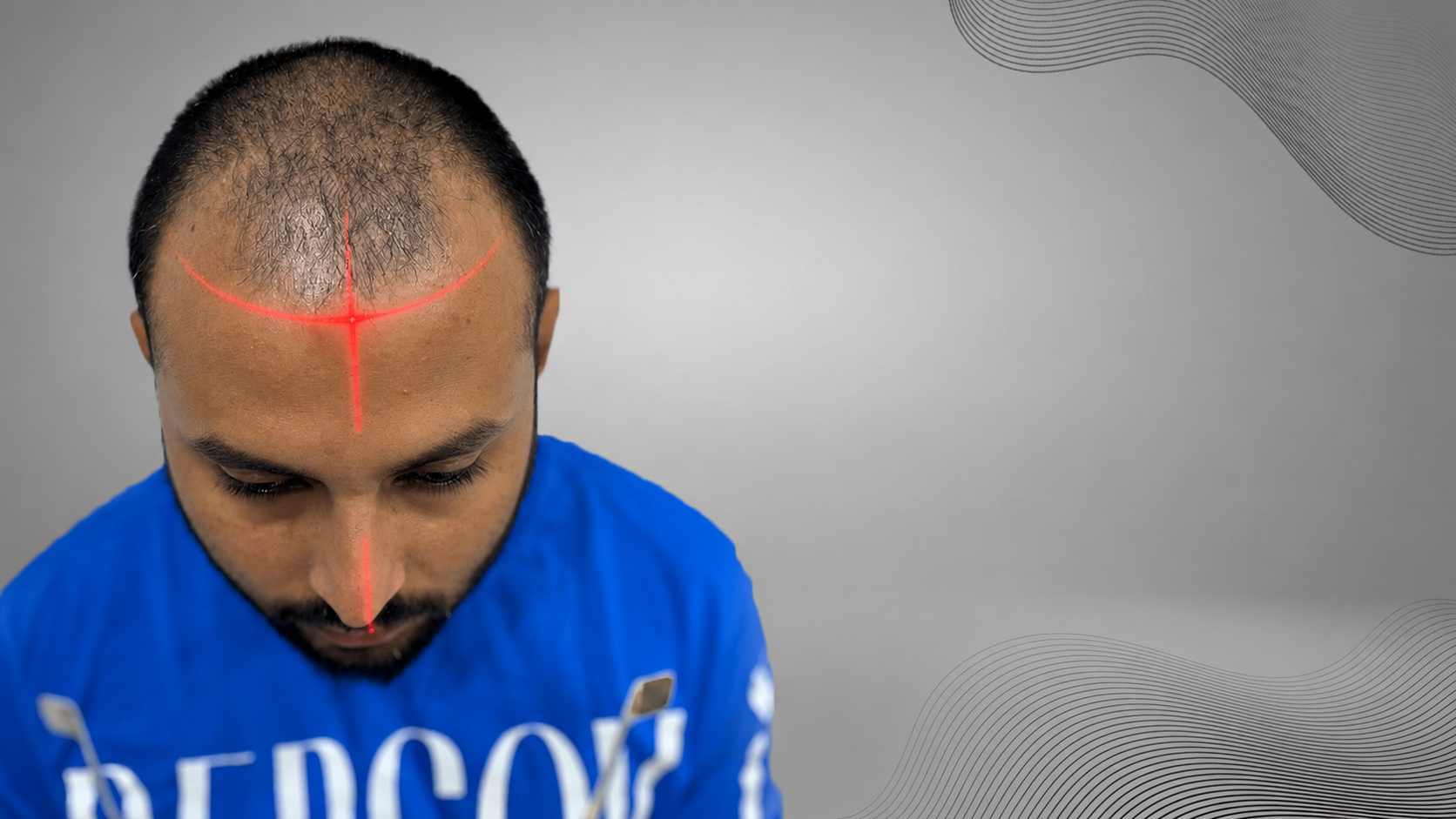Hairline Reconstruction