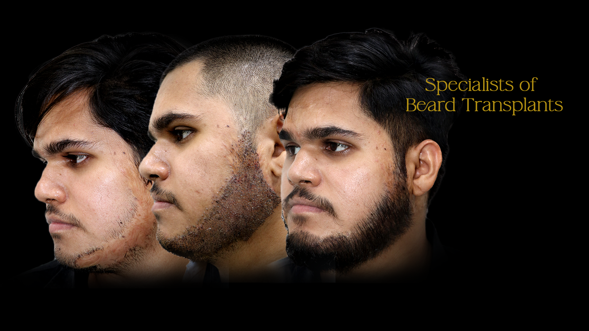 Hair Transplant Cost in Bangalore 3