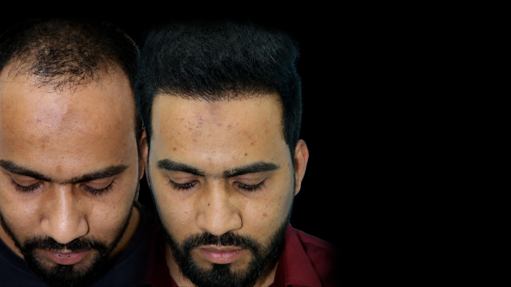 Hair Transplant Surgery in India