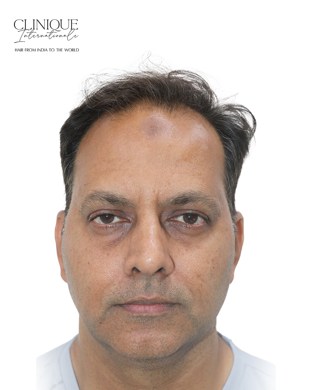 Patient before hair transplant