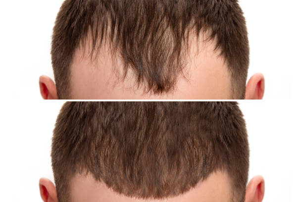 PRP hair regrowth result