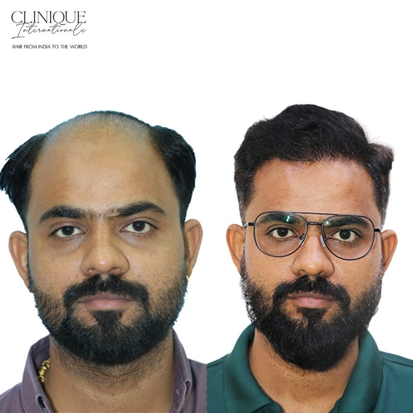 Hair Transplant in Bengaluru