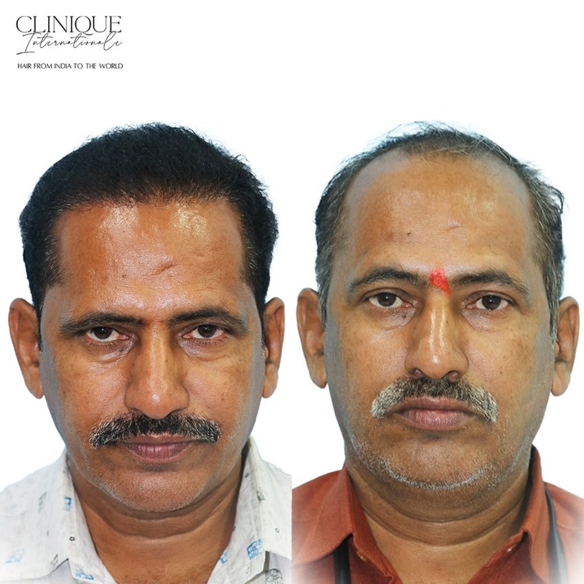 Hair Transplant in Ahmedabad
