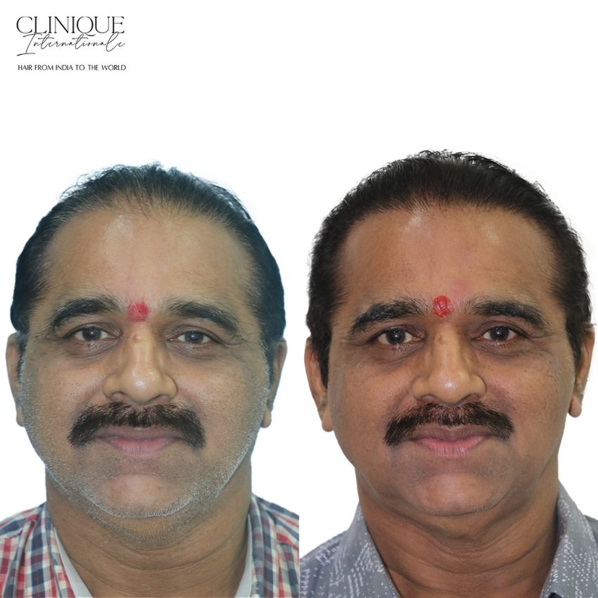 Hair Transplant in Kanpur