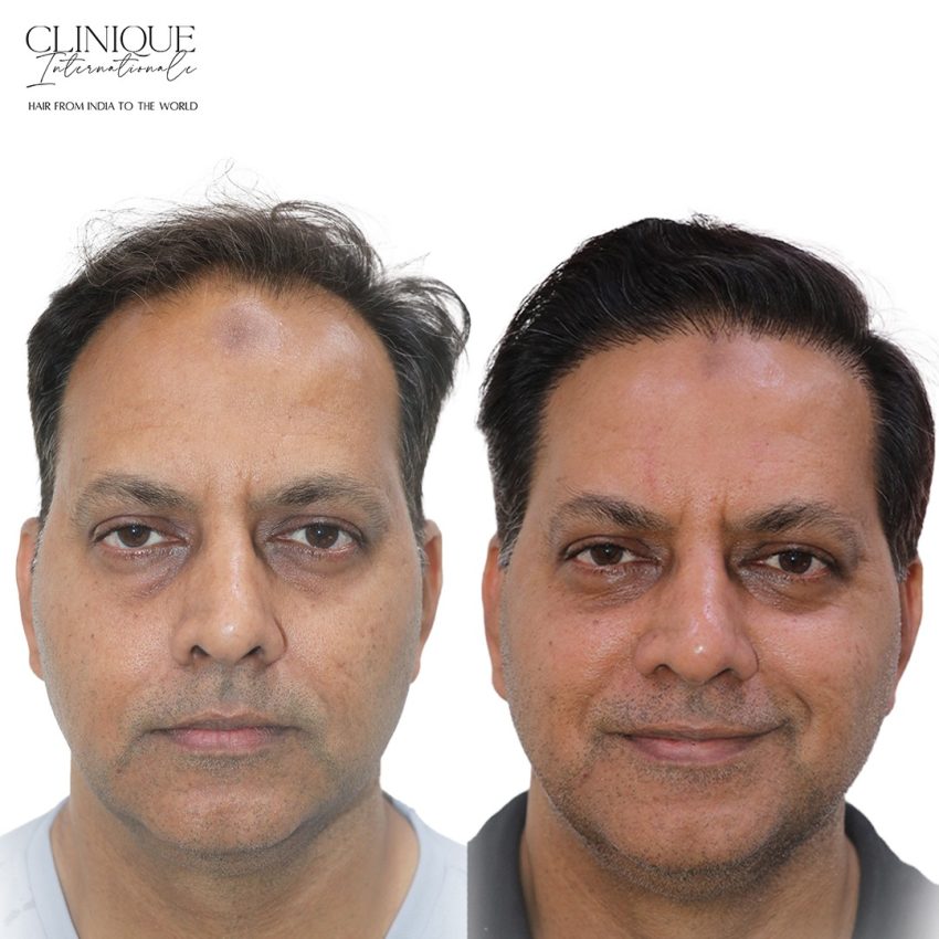 Hair Transplant in Goa