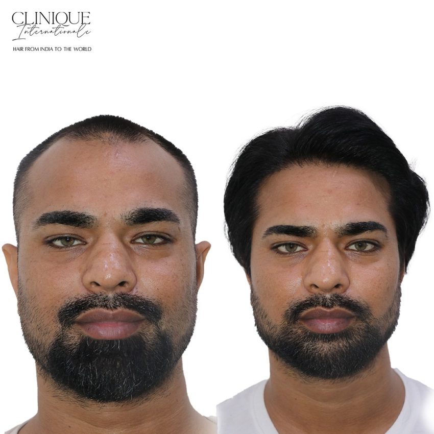 Hair Transplant in Gurugram