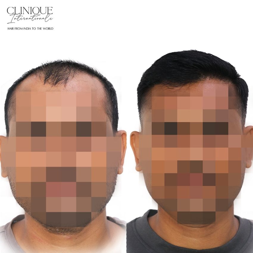 Hair Transplant in Ghansoli