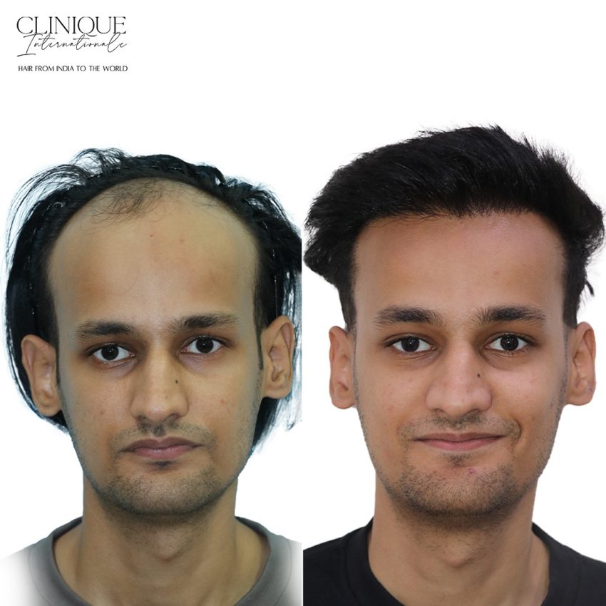 Hair Transplant in Ghodbunder Road