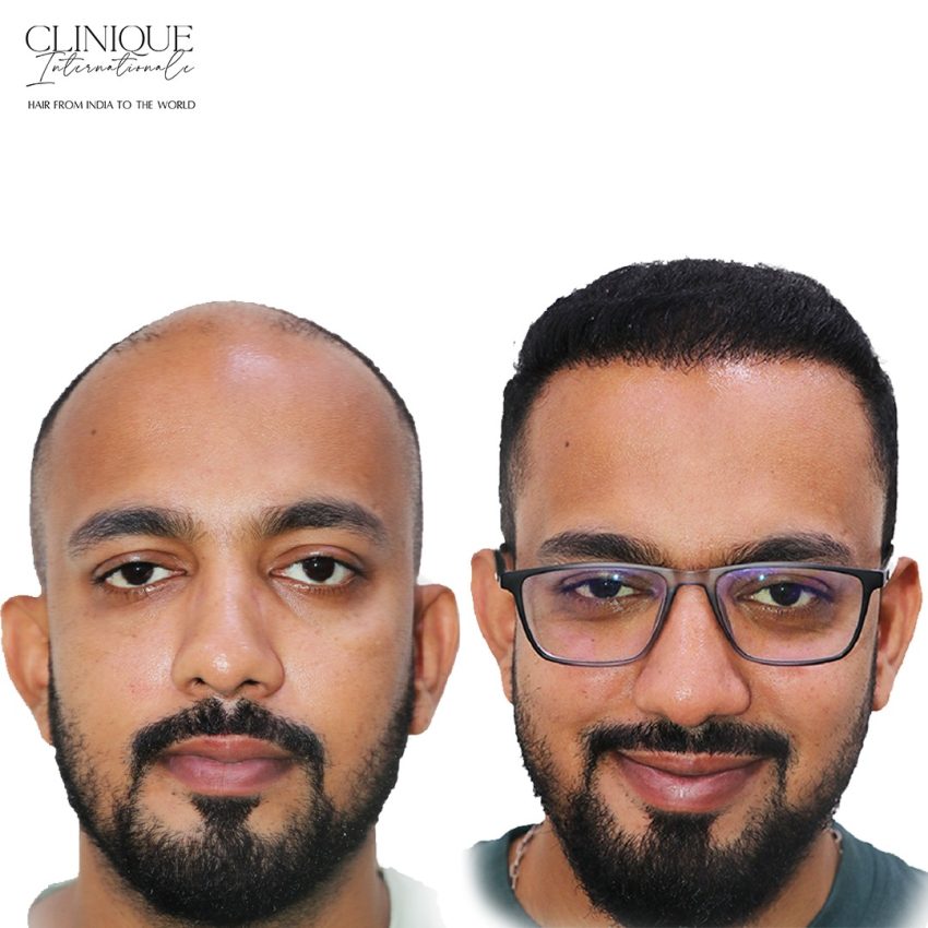 Hair Transplant in Jodhpur