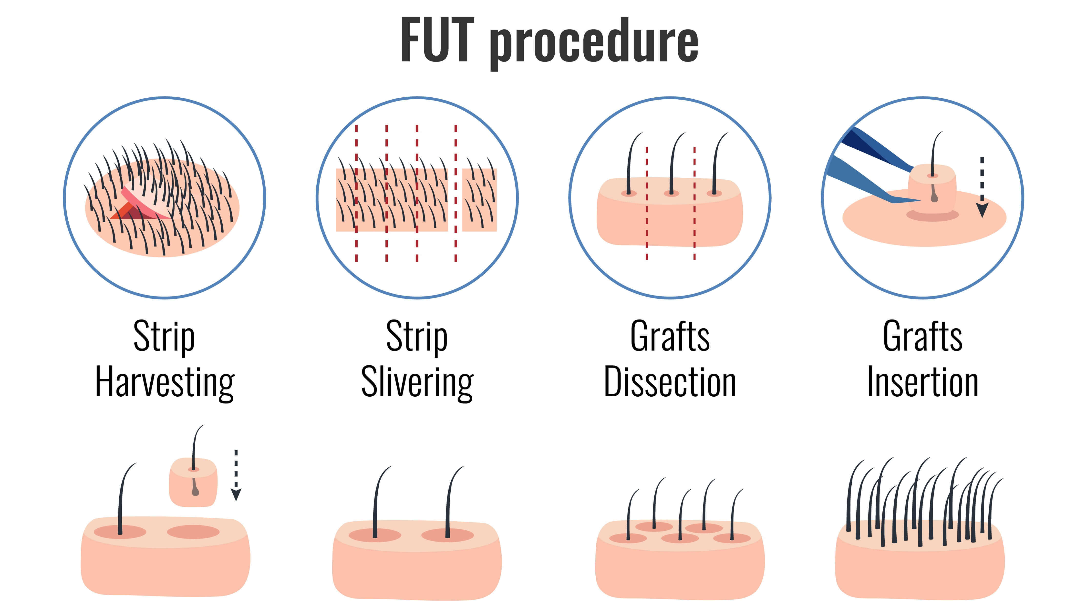 FUT (Follicular Unit Transplantation)