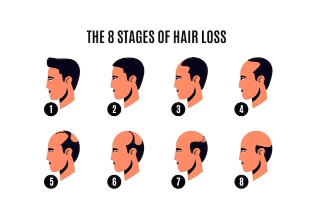 Stages of hair loss