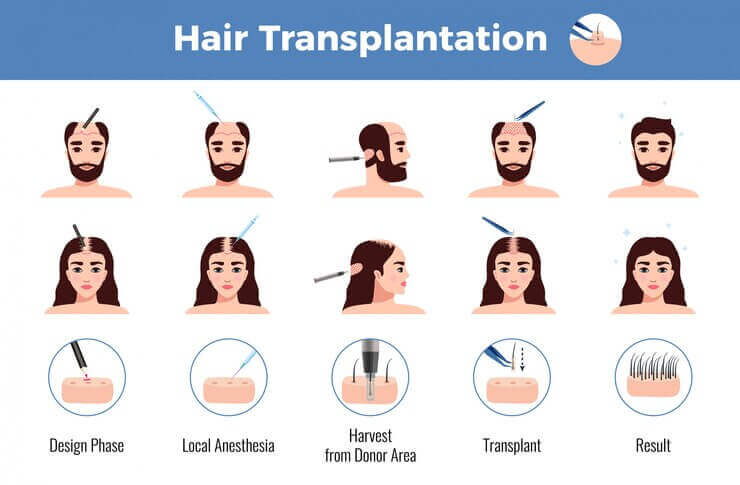 Procedure of Hair Transplant 